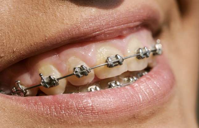 Stainless steel braces
