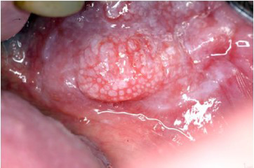 An exophytic growth with a granular surface showing features of a squamous cell carcinoma
