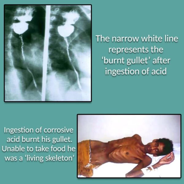 HE TRAGEDY OF A BURNT GULLET 01