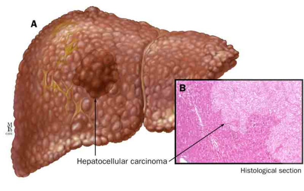 liver disease