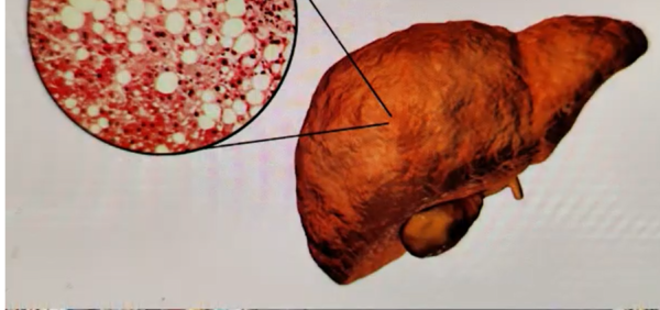 Liver