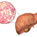 Fatty Liver | elanka