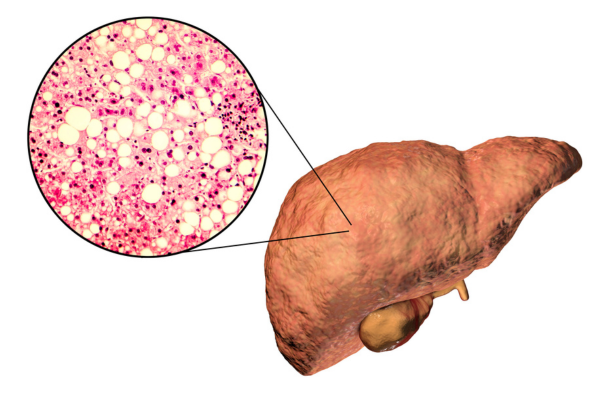 Fatty Liver | elanka