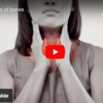 osteoporosis