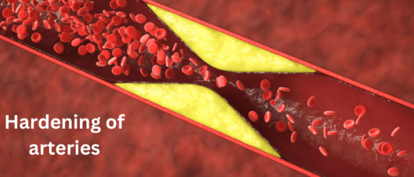hardening of arteries