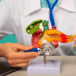 pancreatic cancer