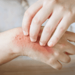 The Impact of Fungus on the Human Body: Causes, Effects, and Prevention - By Bhanuka - eLanka